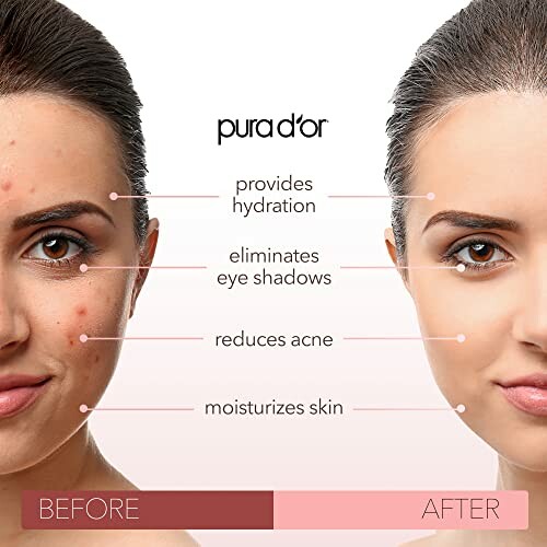 Before and after skincare results showing reduced acne and improved skin appearance.